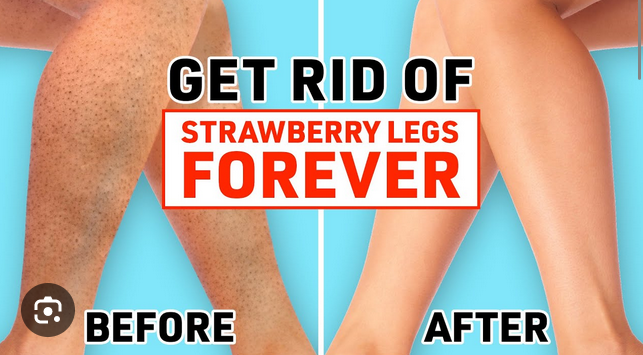 Say Goodbye to Strawberry Legs: 8 Effective Solutions