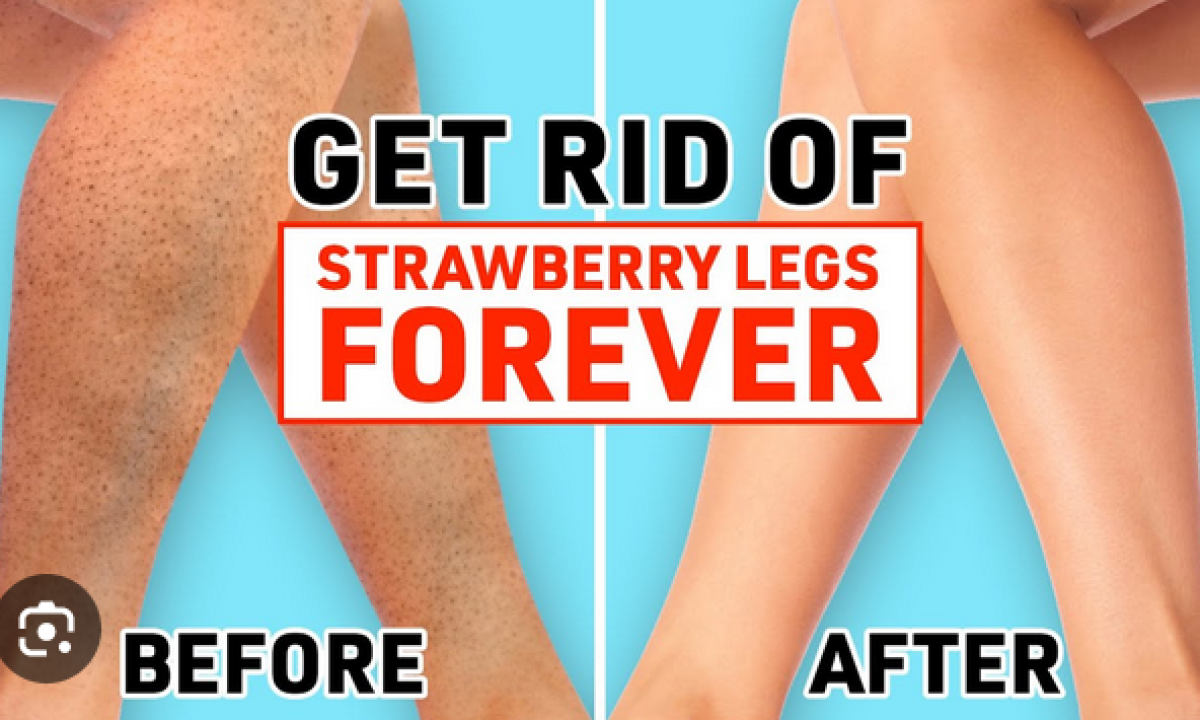 Say Goodbye to Strawberry Legs: 8 Effective Solutions